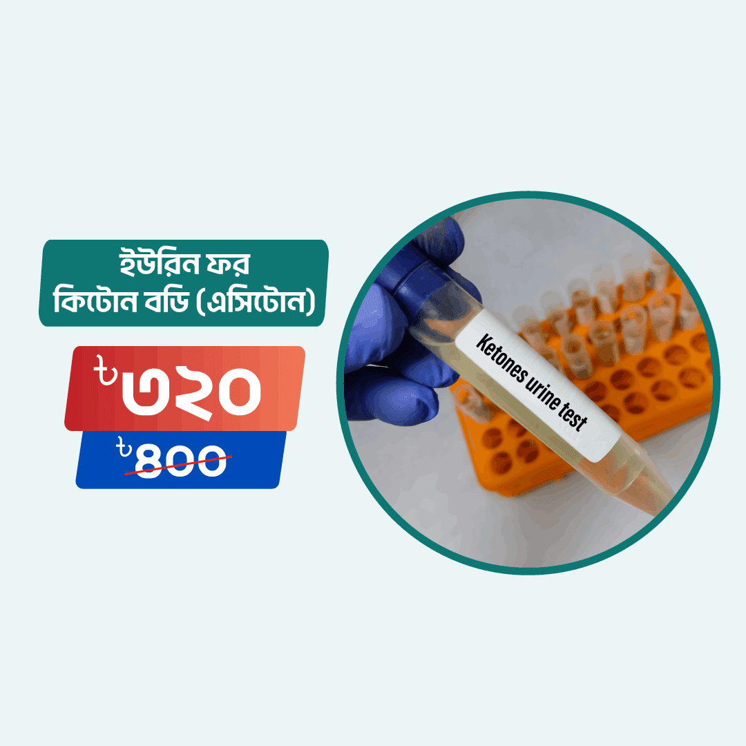 Urine Ketone Body (Acetone)