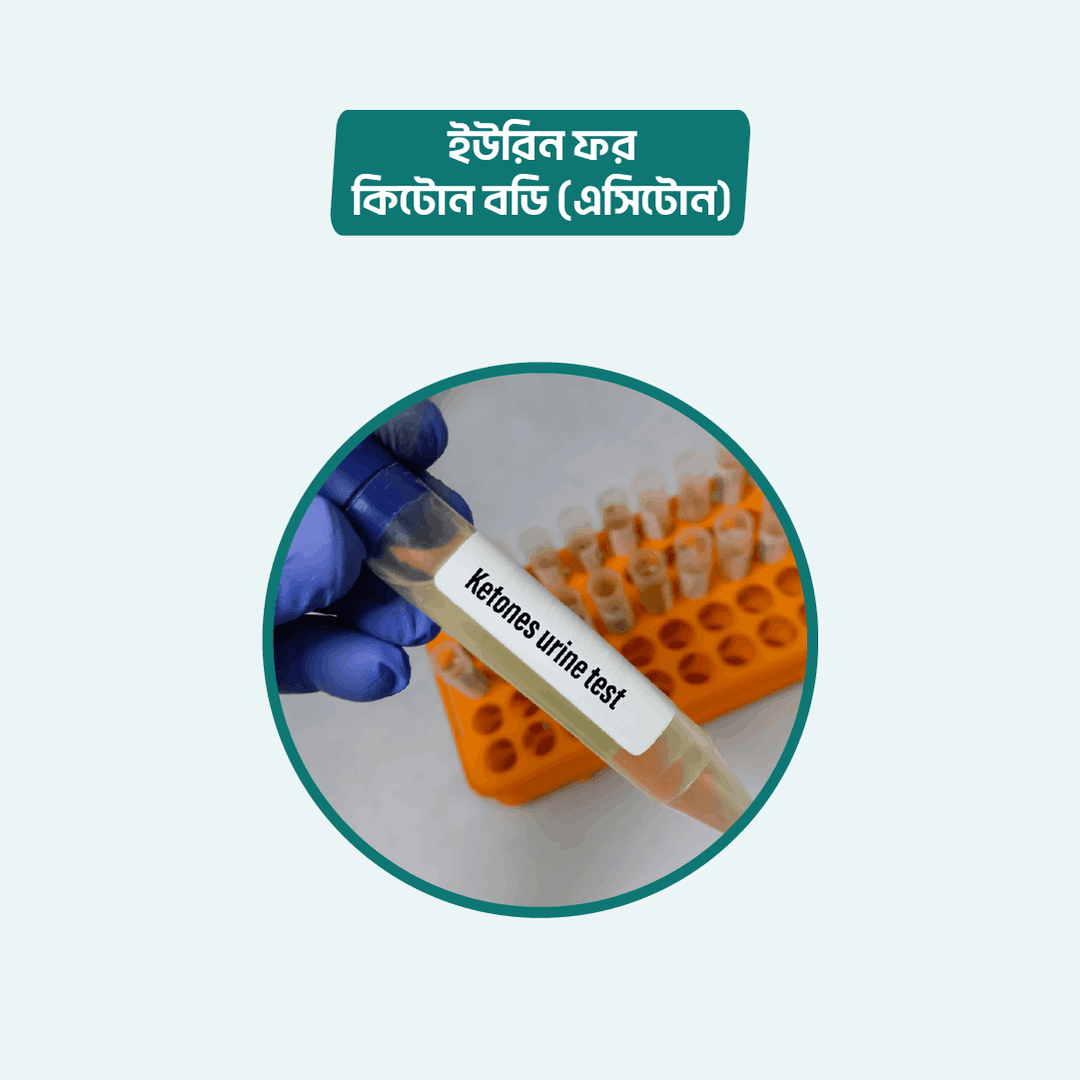 Urine for Ketone Bodies