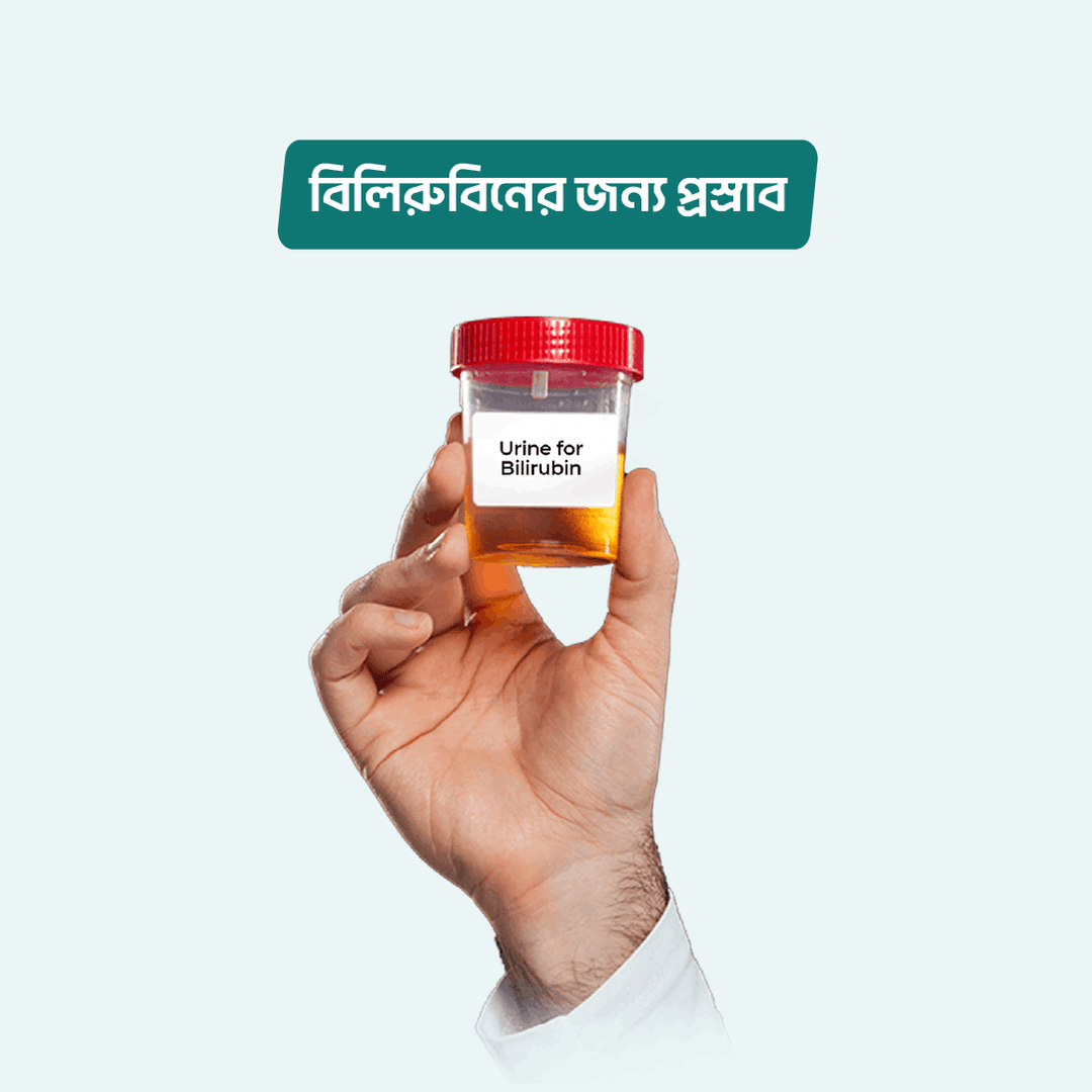 Urine for Bilirubin