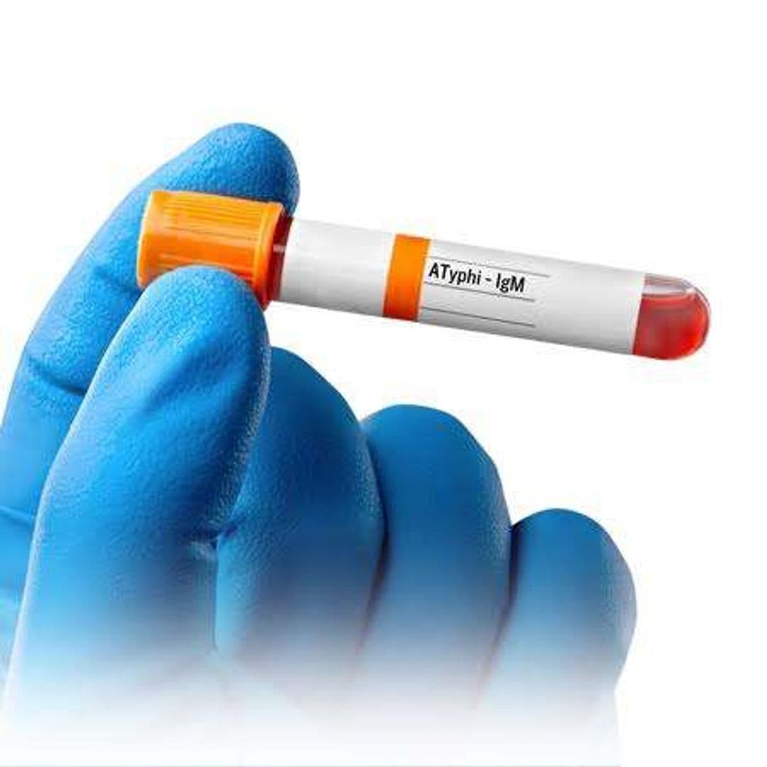 TYPHI DOT/ SALMONELLA TYPHI IGM