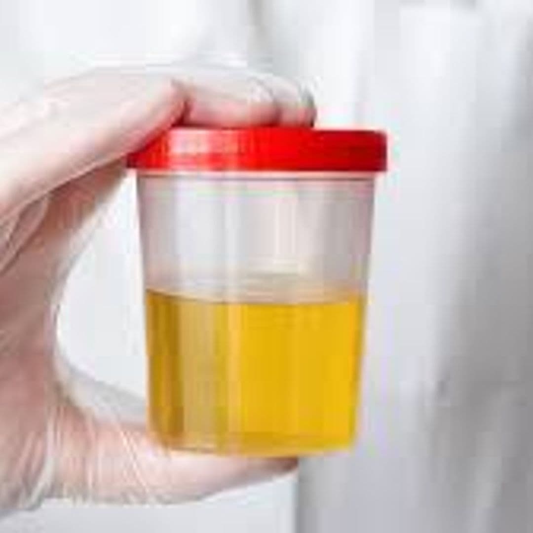 Urine R/S (Reducing Substance)